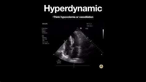 hyperdynamic lv meaning